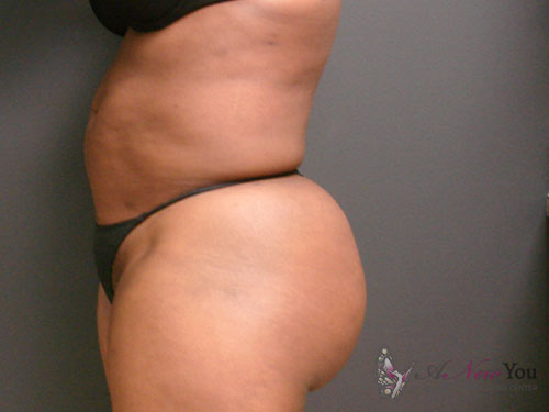 Brazilian Butt Lift After Brazilian Butt Lift After - Chicago, IL