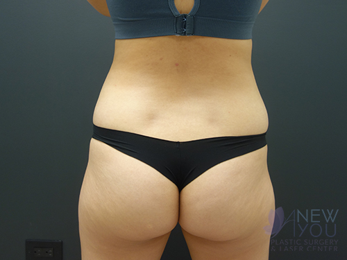 Brazilian Butt Lift Before Brazilian Butt Lift Before - Chicago, IL