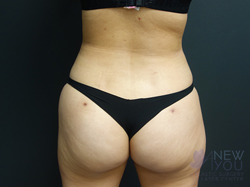 Brazilian Butt Lift After Brazilian Butt Lift After - Chicago, IL