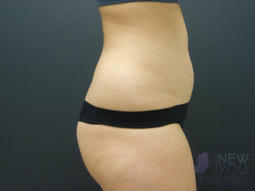 Brazilian Butt Lift Before Brazilian Butt Lift Before - Chicago, IL