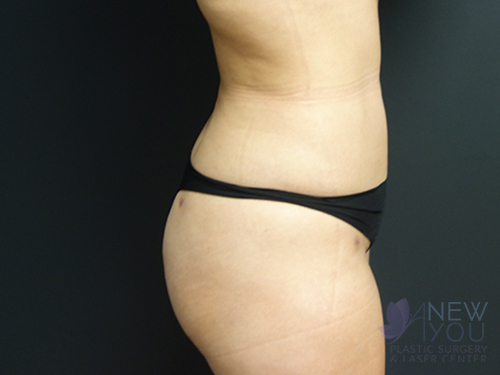 Brazilian Butt Lift After Brazilian Butt Lift After - Chicago, IL