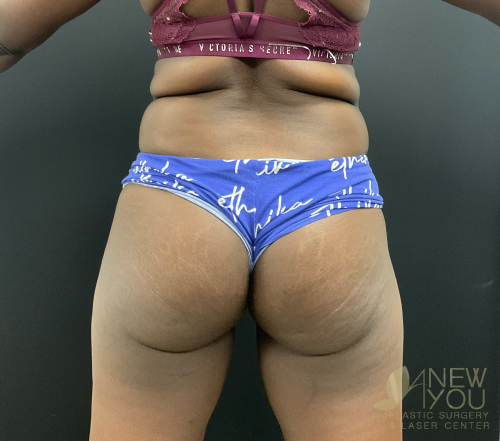 Brazilian Butt Lift Before Brazilian Butt Lift Before - Chicago, IL