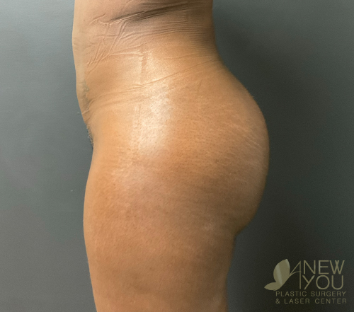 Brazilian Butt Lift After Brazilian Butt Lift After - Chicago, IL