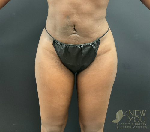 Brazilian Butt Lift After Brazilian Butt Lift After - Chicago, IL