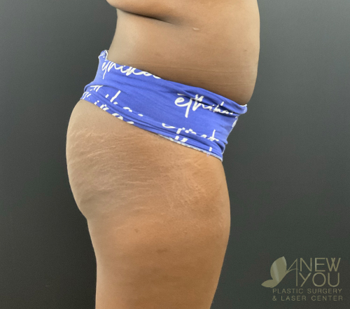 Brazilian Butt Lift Before Brazilian Butt Lift Before - Chicago, IL