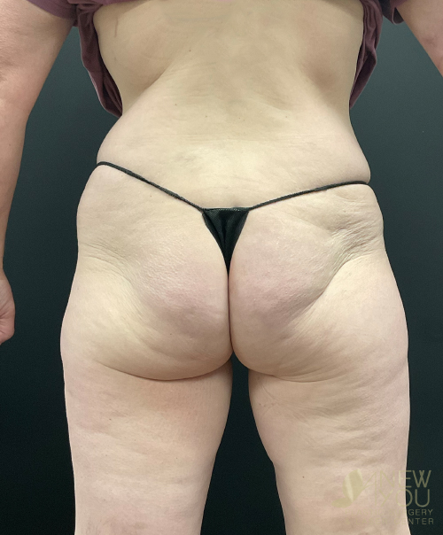 Brazilian Butt Lift Before Brazilian Butt Lift Before - Chicago, IL