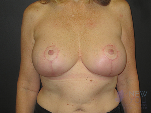 Breast Augmentation with Lift (Mastopexy) After - Chicago, IL