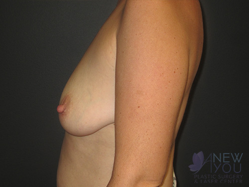 Breast Augmentation with Lift (Mastopexy) Before - Chicago, IL