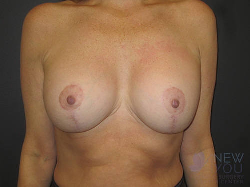 Breast Augmentation with Lift (Mastopexy) After - Chicago, IL