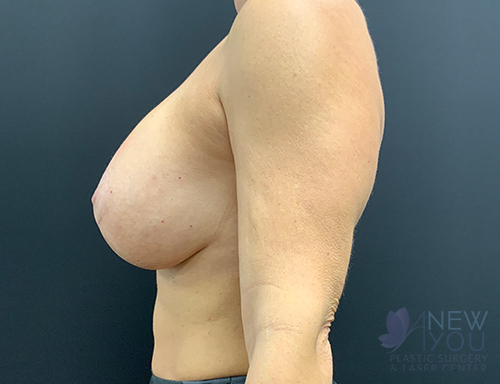 Breast Augmentation with Lift (Mastopexy) After - Chicago, IL