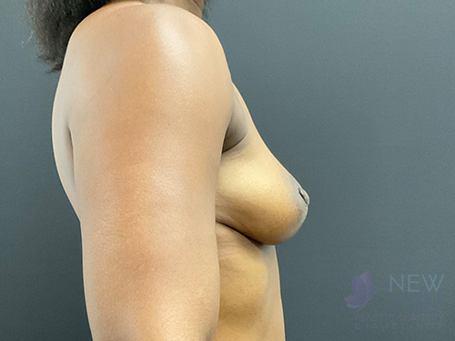 Breast Augmentation with Lift (Mastopexy) Before - Chicago, IL