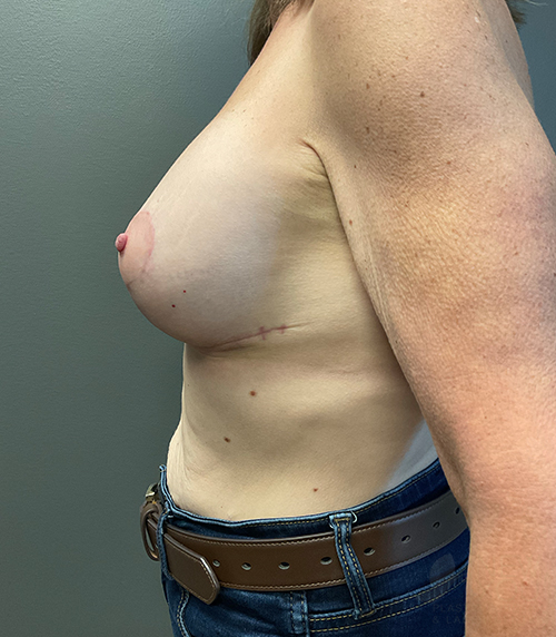 Breast Augmentation with Lift (Mastopexy) After - Chicago, IL