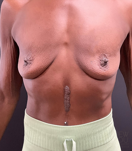 Breast Augmentation with Lift (Mastopexy) Before - Chicago, IL