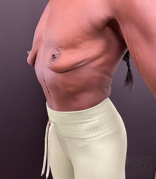 Breast Augmentation with Lift (Mastopexy) Before - Chicago, IL