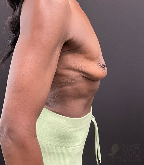 Breast Augmentation with Lift (Mastopexy) Before - Chicago, IL