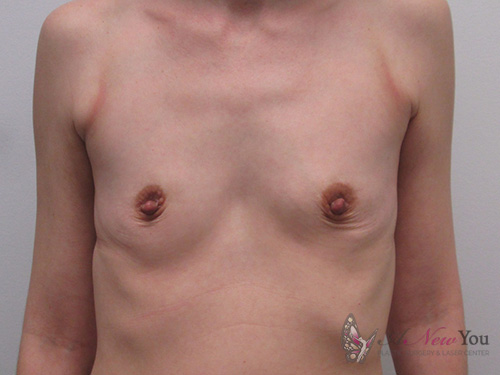 Breast Augmentation Before - Chicago, IL