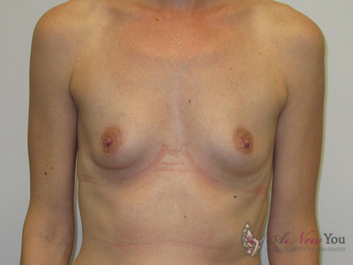 Breast Augmentation Before - Chicago, IL