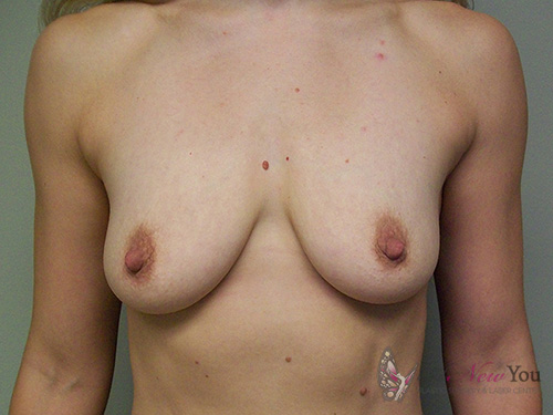 Breast Augmentation Before - Chicago, IL