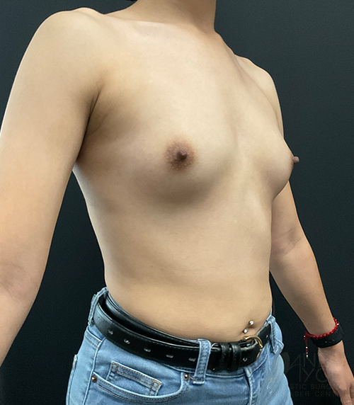 Breast Augmentation Before - Chicago, IL