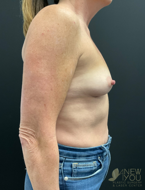 Breast Augmentation Before Breast Augmentation Before - Chicago, IL