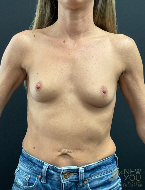 Breast Augmentation Before Breast Augmentation Before - Chicago, IL
