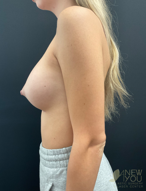Breast Augmentation After Breast Augmentation After - Chicago, IL