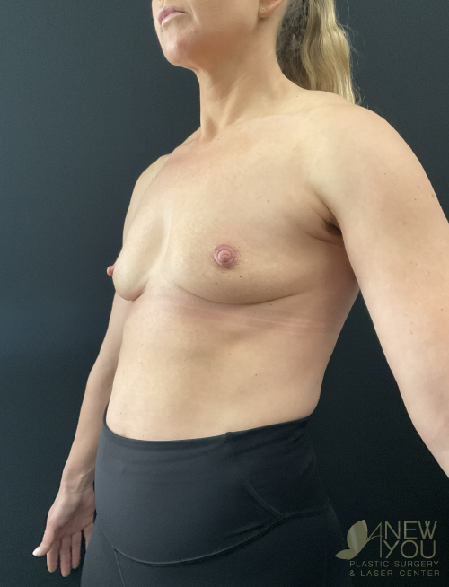 Breast Augmentation Before Breast Augmentation Before - Chicago, IL