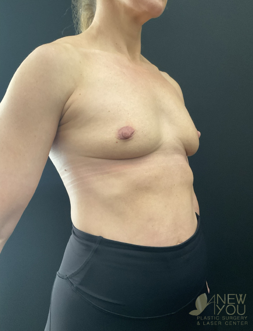 Breast Augmentation Before Breast Augmentation Before - Chicago, IL