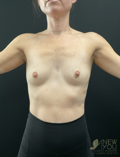 Breast Augmentation Before Breast Augmentation Before - Chicago, IL