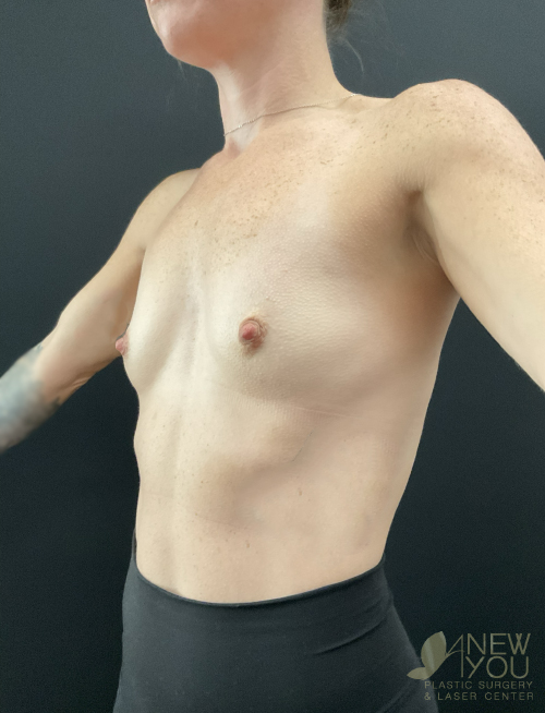 Breast Augmentation Before Breast Augmentation Before - Chicago, IL