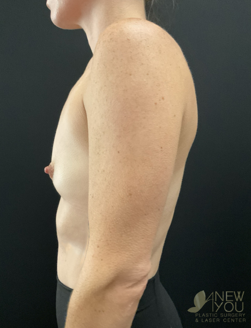Breast Augmentation Before Breast Augmentation Before - Chicago, IL