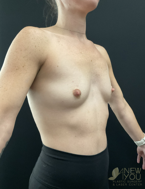 Breast Augmentation Before Breast Augmentation Before - Chicago, IL