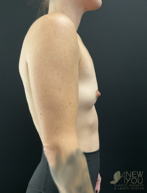 Breast Augmentation Before Breast Augmentation Before - Chicago, IL