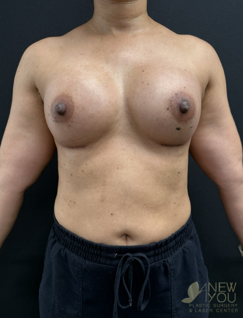 Breast Augmentation After Breast Augmentation After - Chicago, IL