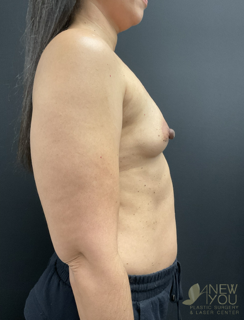 Breast Augmentation Before Breast Augmentation Before - Chicago, IL
