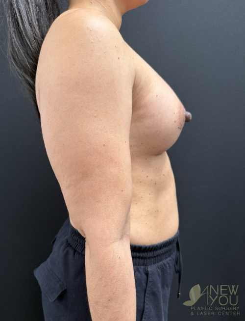Breast Augmentation After Breast Augmentation After - Chicago, IL