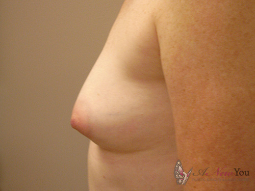 Breast Augmentation Before - Chicago, IL