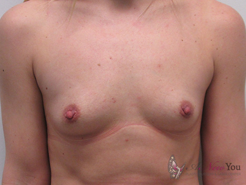 Breast Augmentation Before - Chicago, IL