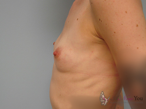 Breast Augmentation Before - Chicago, IL