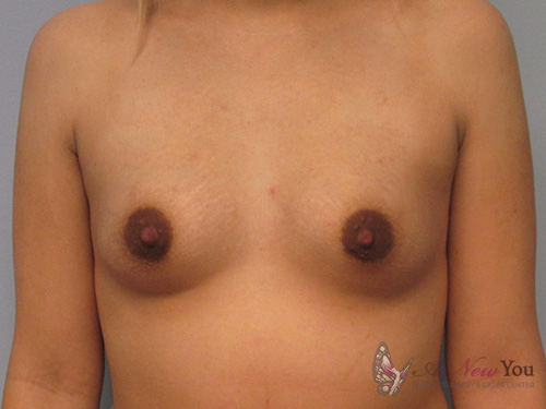 Breast Augmentation Before - Chicago, IL