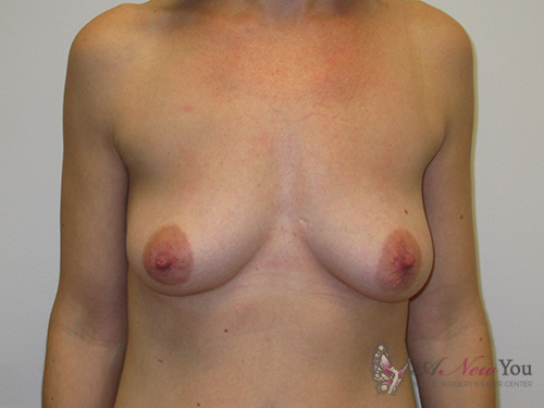 Breast Augmentation Before Breast Augmentation Before - Chicago, IL