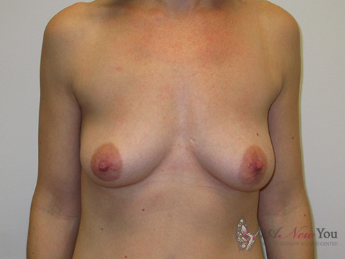 Breast Augmentation Before - Chicago, IL