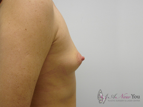 Breast Augmentation Before - Chicago, IL