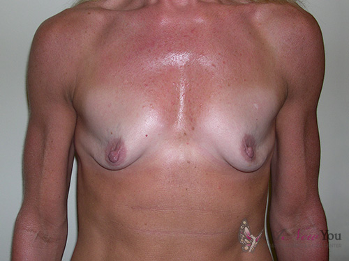 Breast Augmentation Before - Chicago, IL