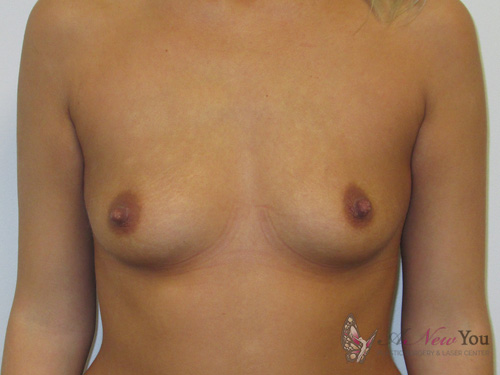 Breast Augmentation Before - Chicago, IL