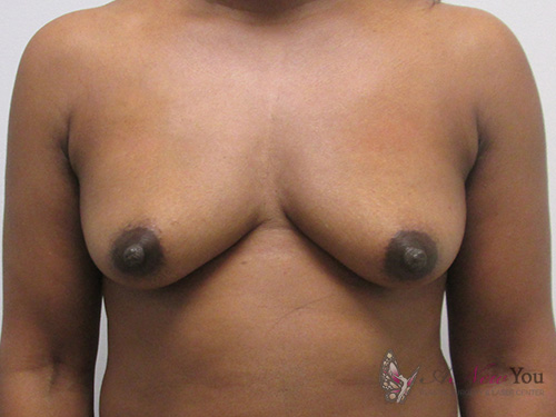 Breast Augmentation Before - Chicago, IL