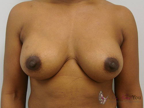 Breast Augmentation After - Chicago, IL