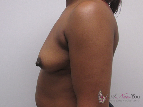 Breast Augmentation Before - Chicago, IL