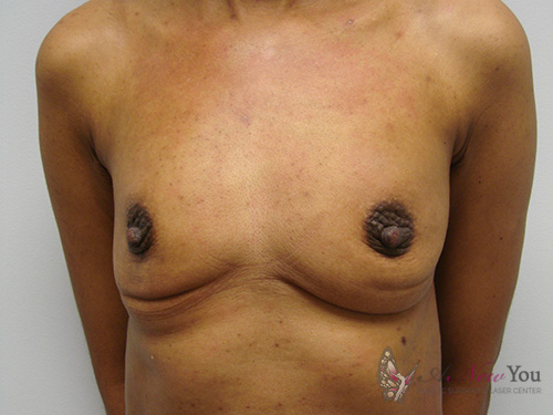 Breast Augmentation Before - Chicago, IL