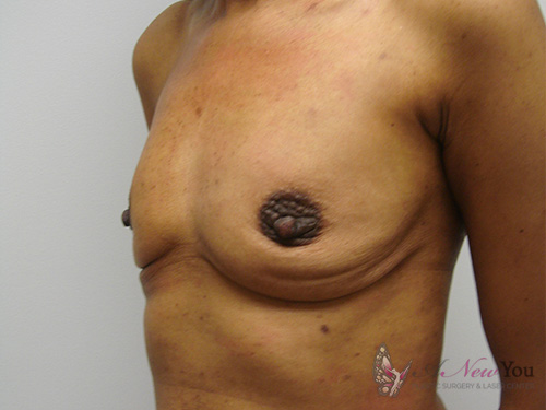 Breast Augmentation Before - Chicago, IL